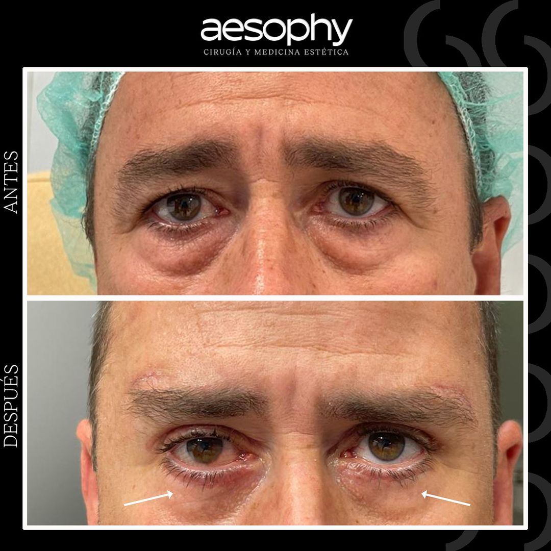 Blefaroplastia Superior e Inferior en Málaga: Clínica Aesophy