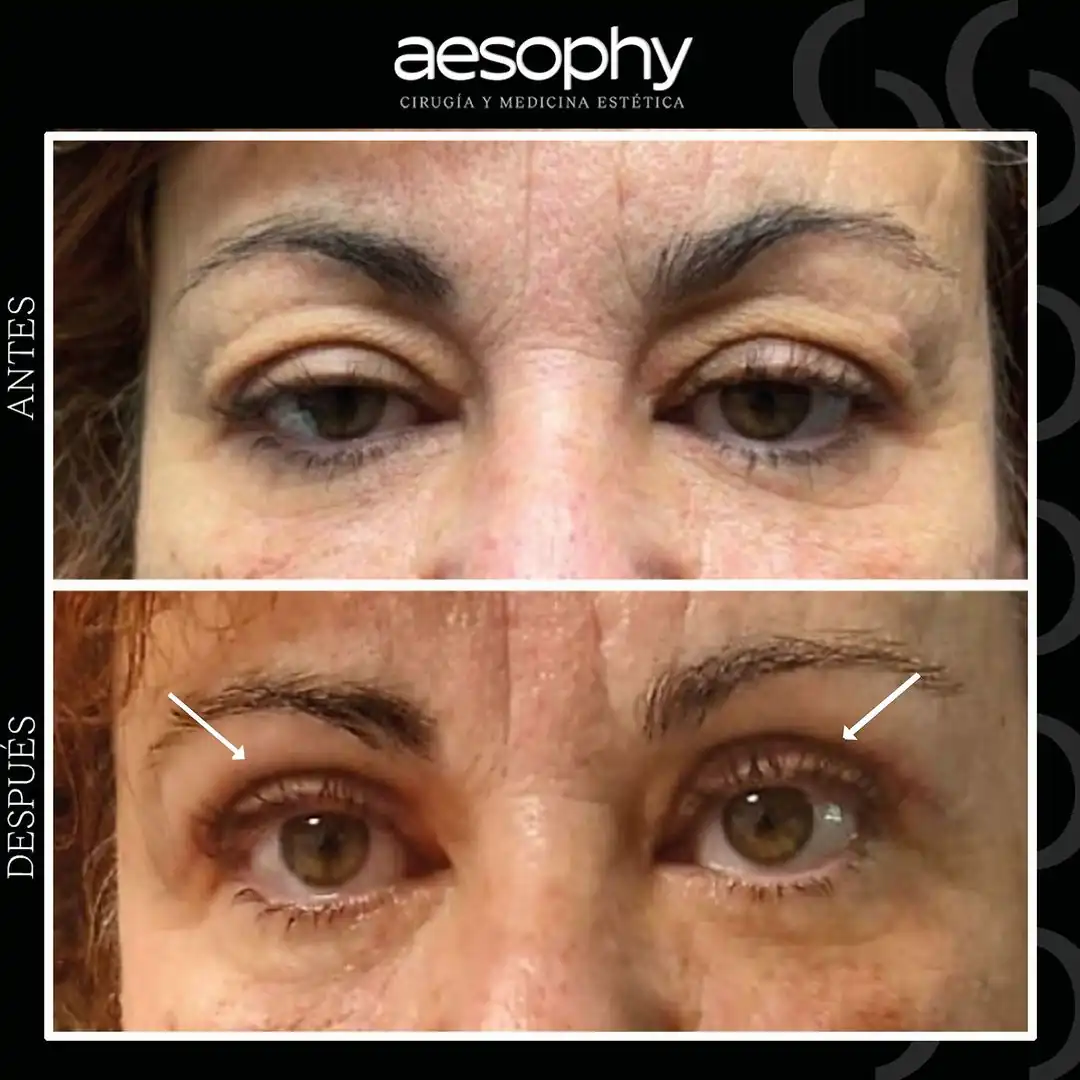 Blefaroplastia Superior e Inferior en Málaga: Clínica Aesophy