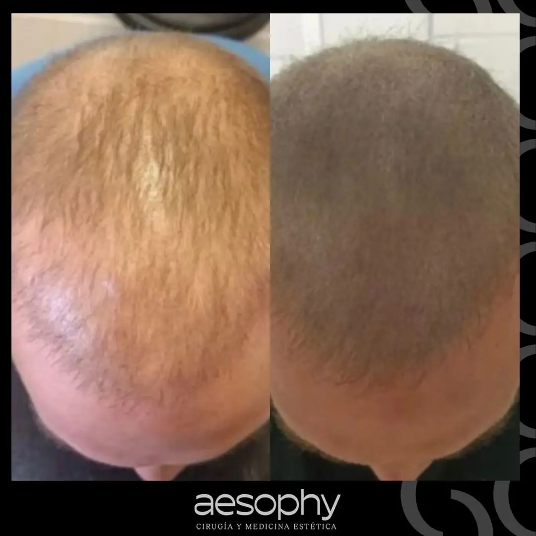Antes y después micropigmentación capilar Málaga Clínica Aesophy