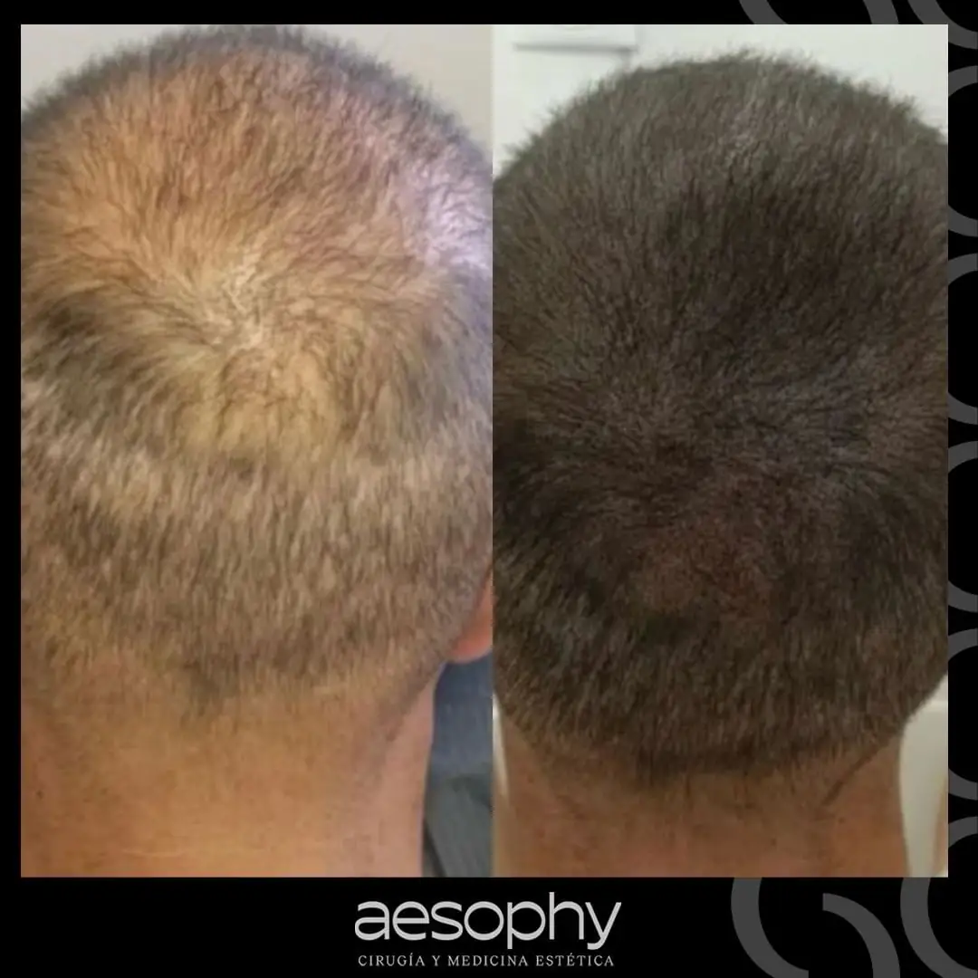 Antes y después micropigmentación capilar