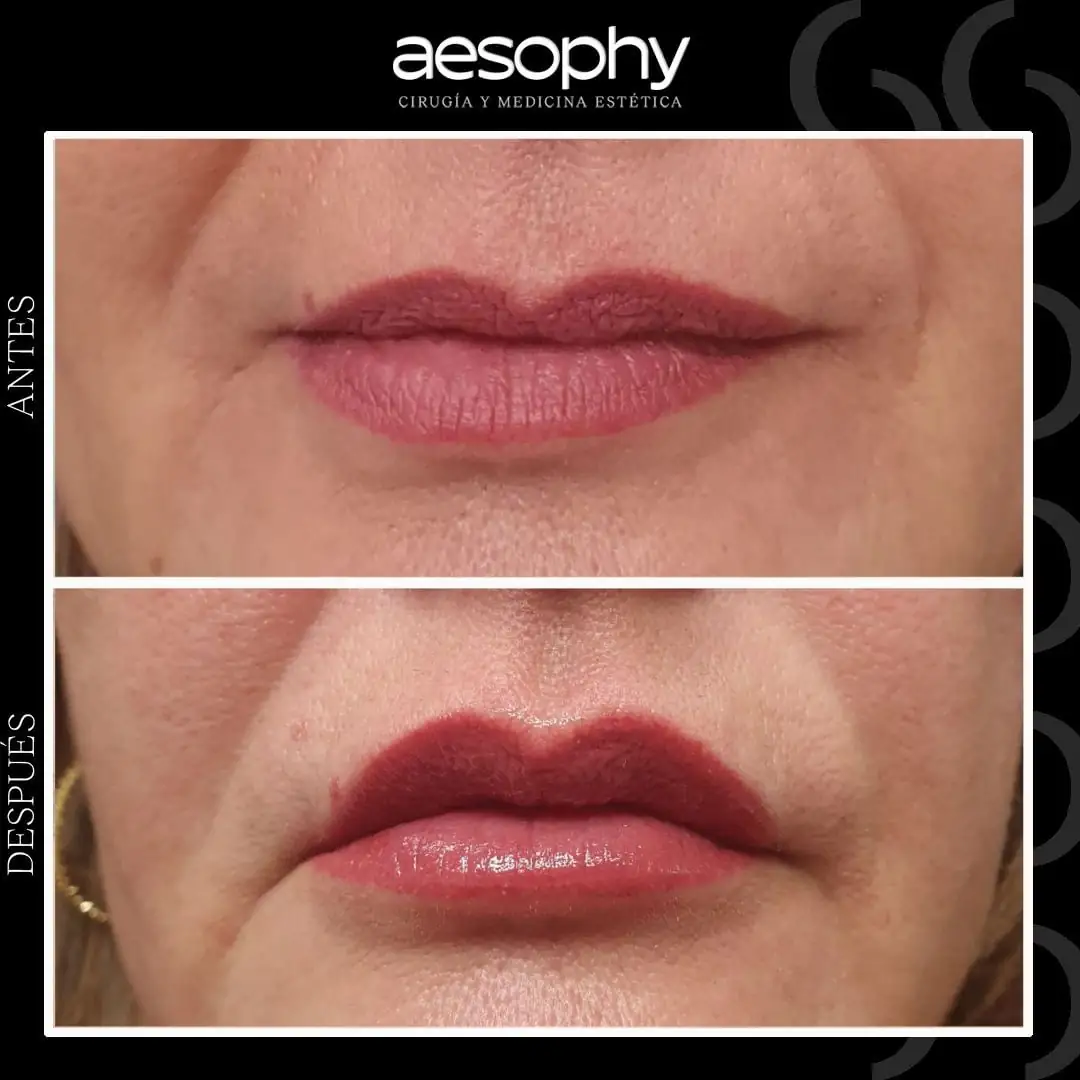 Antes y Después microblading de labios perfilado y volumen Clínica Aesophy