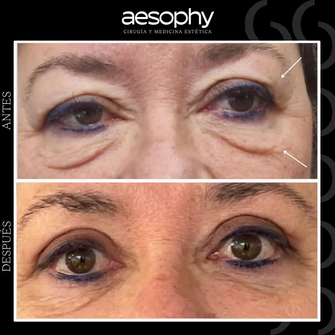 Blefaroplastia Superior e Inferior en Málaga: Clínica Aesophy