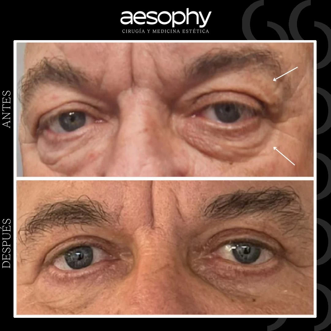 Blefaroplastia Superior e Inferior en Málaga: Clínica Aesophy