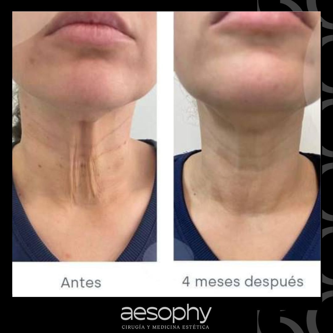 Antes y después rejuvenecimiento de cuello Málaga Clínica Aesophy